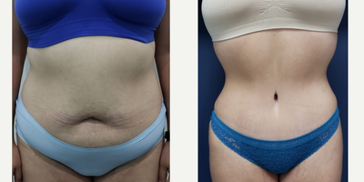 Tummy Tuck before and after photo