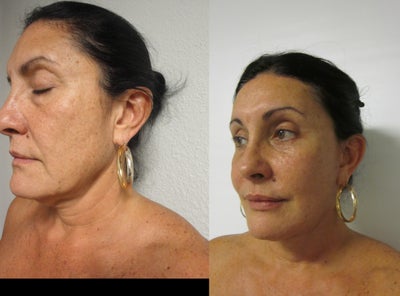 Eyelid Surgery before and after photo