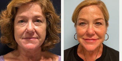before and after image