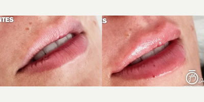 Lip Fillers before and after photo