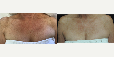 Photodynamic Therapy before and after photo