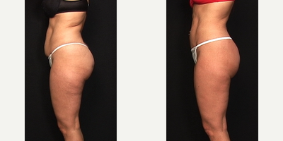 Tummy Tuck before and after photo