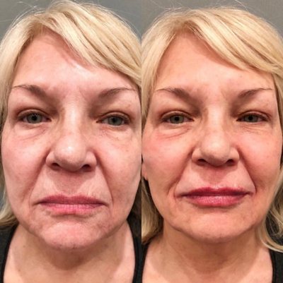 Dermal Fillers before and after photo