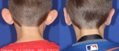 Ear Surgery before and after photo
