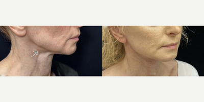 Facelift before and after photo