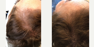 PRP for Hair Loss before and after photo