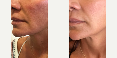 Ultherapy before and after photo