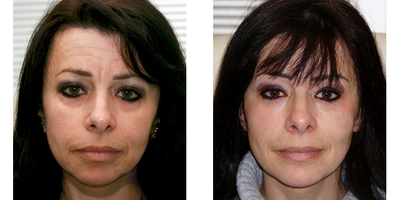 Voluma before and after photo