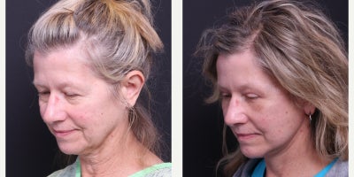 Deep Plane Facelift before and after photo