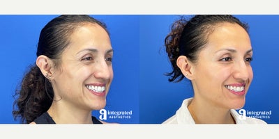Dysport before and after photo