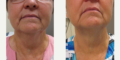 Kybella before and after photo