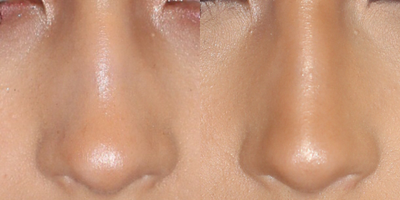 Nonsurgical Nose Job before and after photo