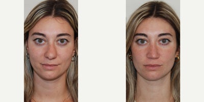 Revision Rhinoplasty before and after photo