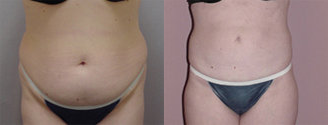 Liposuction before and after photo