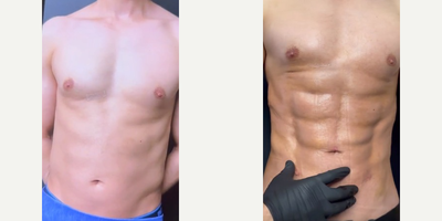 Liposuction before and after photo