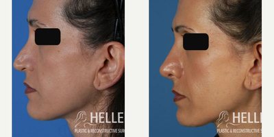 Rhinoplasty before and after photo