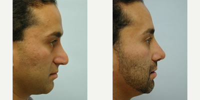 Rhinoplasty before and after photo