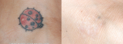 Tattoo Removal before and after photo