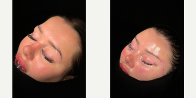 Brow Lift before and after photo