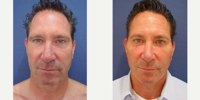 Facelift before and after photo