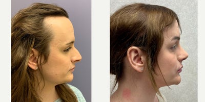 Facial Feminization Surgery before and after photo