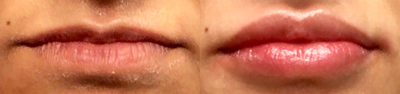 Lip Fillers before and after photo