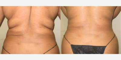 Liposuction before and after photo