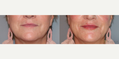 Restylane before and after photo