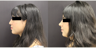 Rhinoplasty before and after photo