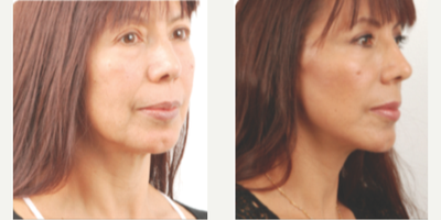 Facelift before and after photo