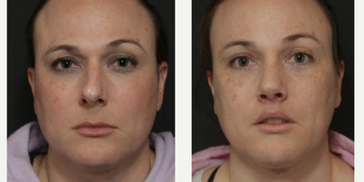 Facial Feminization Surgery before and after photo