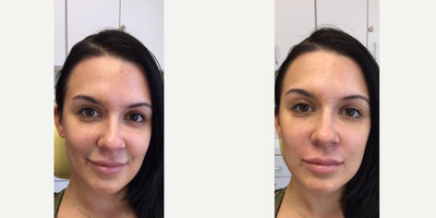 Juvederm before and after photo