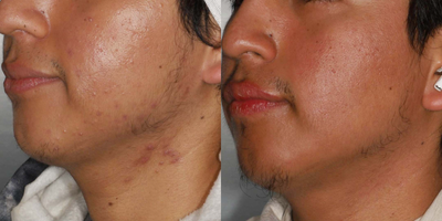 Accutane before and after photo