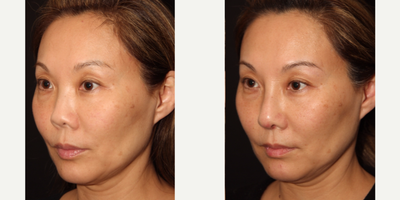 Asian Rhinoplasty before and after photo