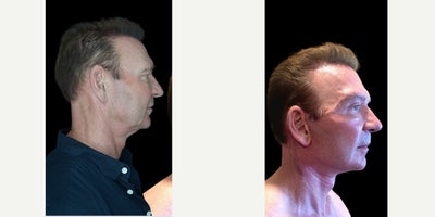 Eyelid Surgery before and after photo
