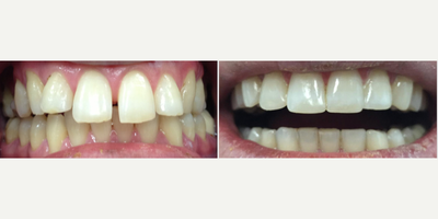 Invisalign before and after photo