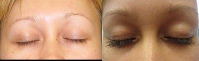 Latisse before and after photo