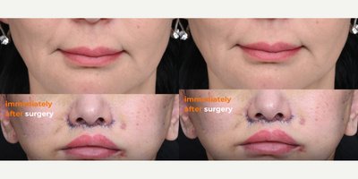 Lip Lift before and after photo