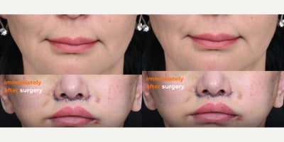 Lip Lift before and after photo