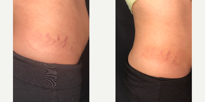 Microneedling before and after photo