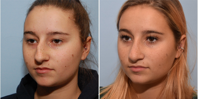 Rhinoplasty before and after photo