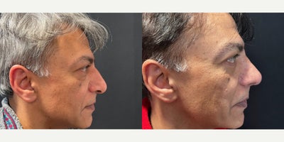 Rhinoplasty before and after photo