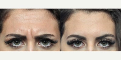 Botox before and after photo