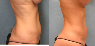 Liposuction before and after photo