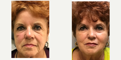 Bellafill before and after photo
