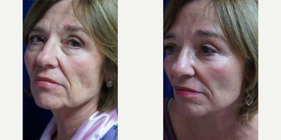 Facelift before and after photo