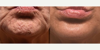 Botox before and after photo