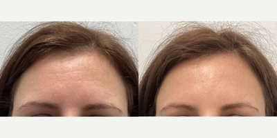 Botox before and after photo