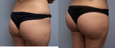 Brazilian Butt Lift before and after photo