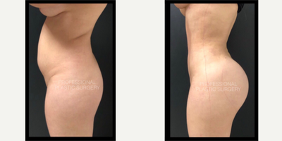 Brazilian Butt Lift before and after photo